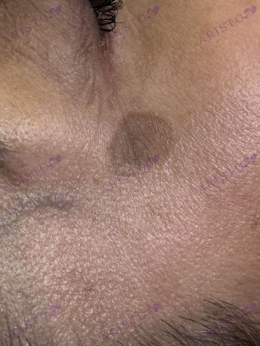 Фото до процедуры - фото